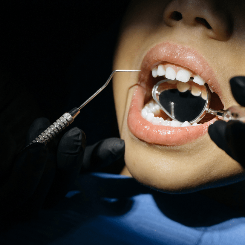 Dental Bonding