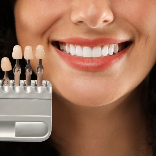 Composite Veneers